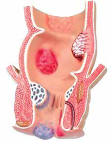 Pathological Model of the Rectum